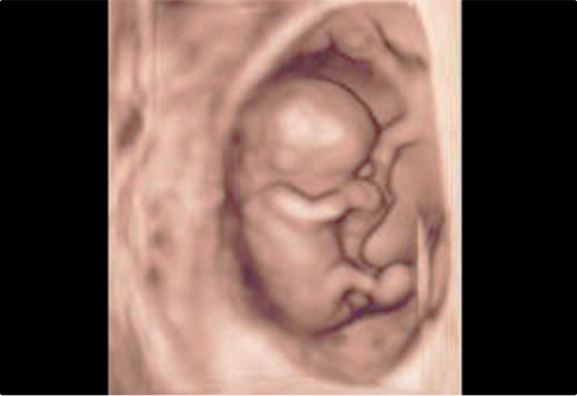 写真：4Dエコーで撮影された胎児
